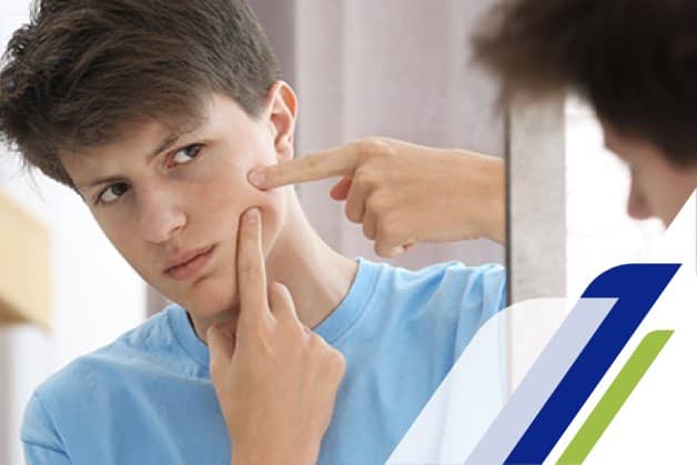 Niño señalando un brote de acné en su rostro frente al espejo, con el acné infantil.
